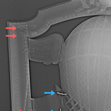 X-radiograph detail of top rail and stile joint of balloon chair